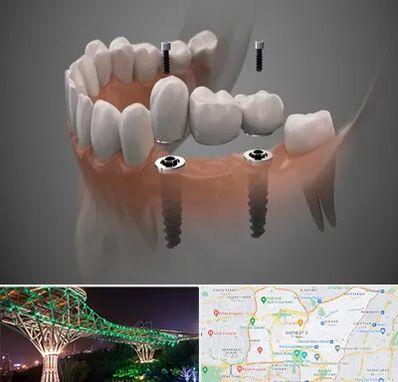 ایمپلنت دیجیتال در منطقه 3 تهران