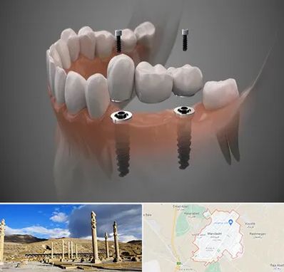 ایمپلنت دیجیتال در مرودشت