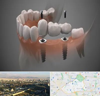 ایمپلنت دیجیتال در منطقه 19 تهران