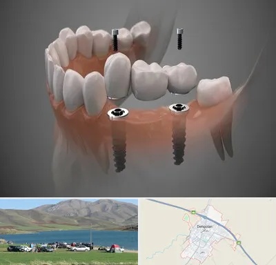 ایمپلنت دیجیتال در دهگلان