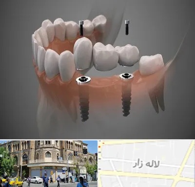ایمپلنت دیجیتال در لاله زار