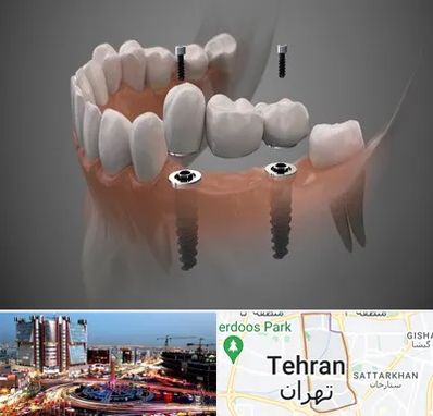 ایمپلنت دیجیتال در صادقیه 