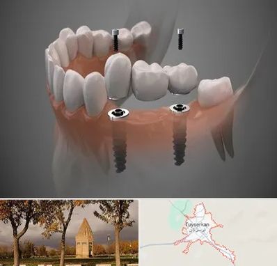 ایمپلنت دیجیتال در تویسرکان