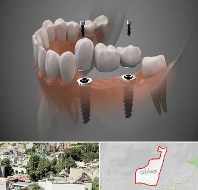 ایمپلنت دیجیتال در جماران