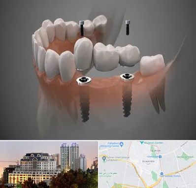 ایمپلنت دیجیتال در فرشته 