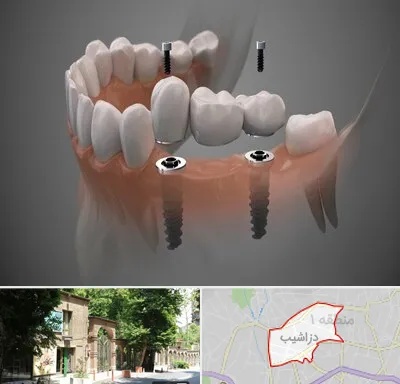 ایمپلنت دیجیتال در دزاشیب