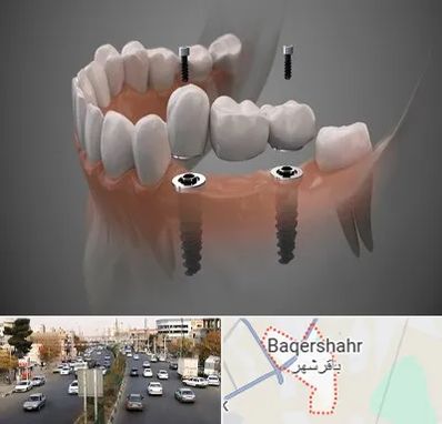 ایمپلنت دیجیتال در باقرشهر