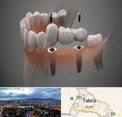 ایمپلنت دیجیتال در تبریز