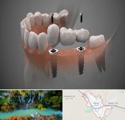 ایمپلنت دیجیتال در دورود