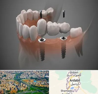 ایمپلنت دیجیتال در اردبیل