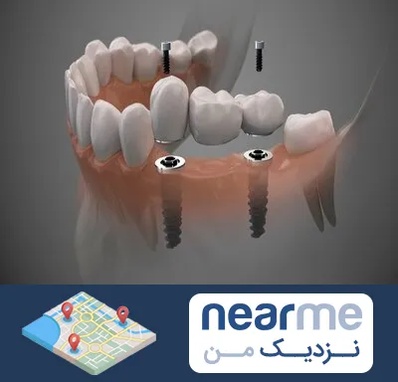 ایمپلنت دیجیتال در نزدیک من