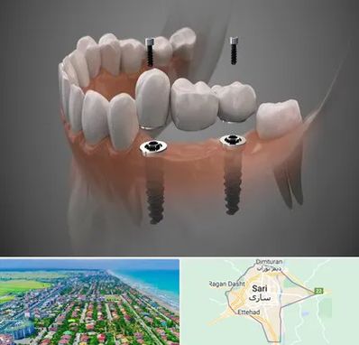 ایمپلنت دیجیتال در ساری