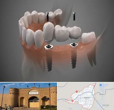 ایمپلنت دیجیتال در ایرانشهر