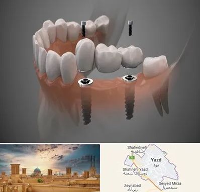 ایمپلنت دیجیتال در یزد
