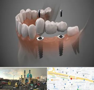 ایمپلنت دیجیتال در رسالت