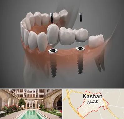 ایمپلنت دیجیتال در کاشان