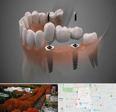 ایمپلنت دیجیتال در منطقه 6 تهران