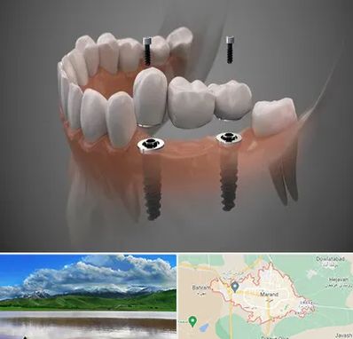 ایمپلنت دیجیتال در مرند