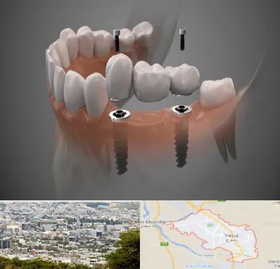 ایمپلنت دیجیتال در یاسوج
