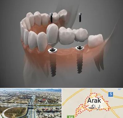 ایمپلنت دیجیتال در اراک