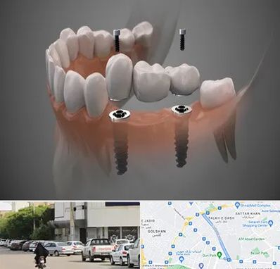 ایمپلنت دیجیتال در قدوسی شرقی شیراز