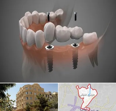 ایمپلنت دیجیتال در مینی سیتی
