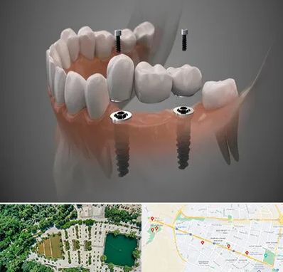 ایمپلنت دیجیتال در وکیل آباد مشهد