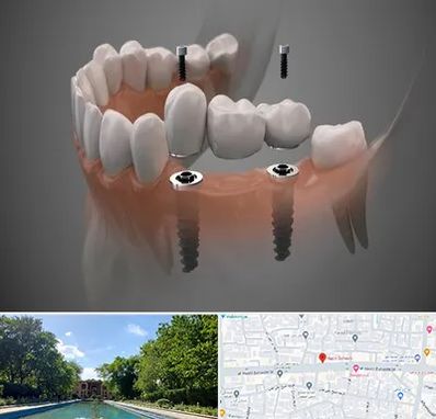 ایمپلنت دیجیتال در هشت بهشت اصفهان