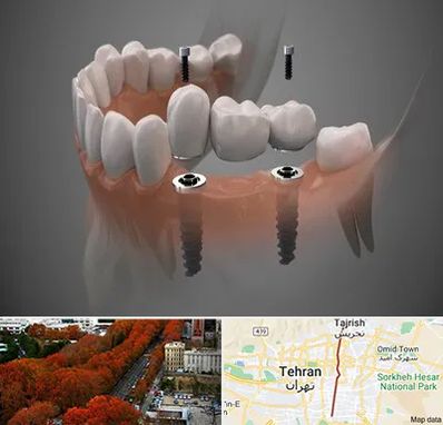 ایمپلنت دیجیتال در ولیعصر 