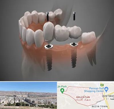 ایمپلنت دیجیتال در شهرک گلستان شیراز