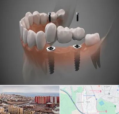 ایمپلنت دیجیتال در سهند تبریز