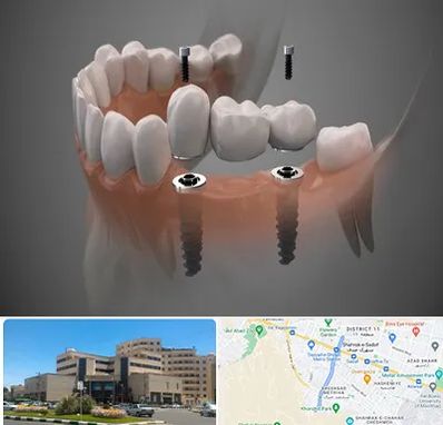 ایمپلنت دیجیتال در صیاد شیرازی مشهد