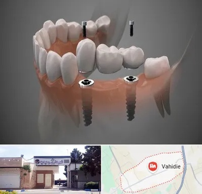 ایمپلنت دیجیتال در وحیدیه شهریار