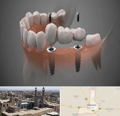 ایمپلنت دیجیتال در سبزوار