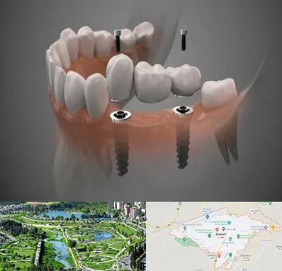 ایمپلنت دیجیتال در بجنورد