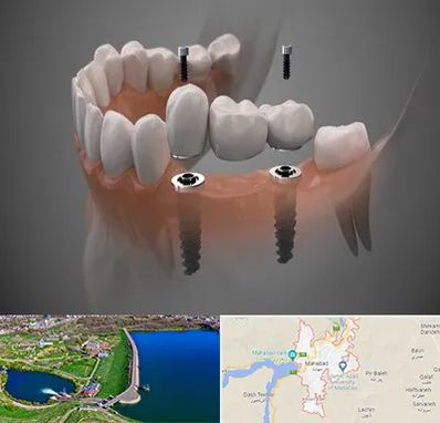 ایمپلنت دیجیتال در مهاباد