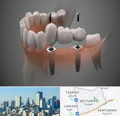 ایمپلنت دیجیتال در قیطریه 