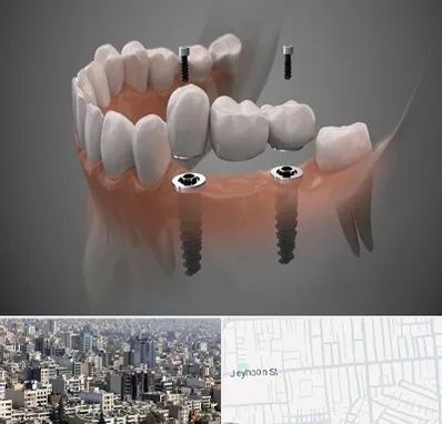 ایمپلنت دیجیتال در جیحون