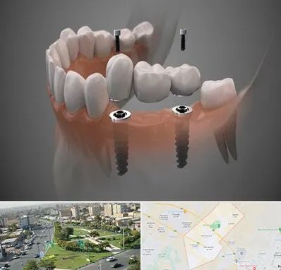 ایمپلنت دیجیتال در کمال شهر کرج