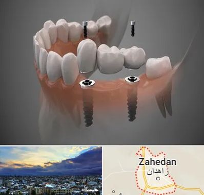 ایمپلنت دیجیتال در زاهدان