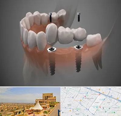 ایمپلنت دیجیتال در هاشمیه مشهد