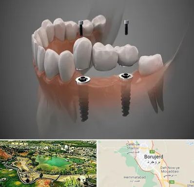 ایمپلنت دیجیتال در بروجرد