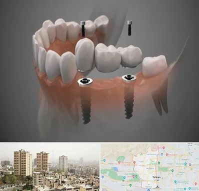 ایمپلنت دیجیتال در منطقه 5 تهران