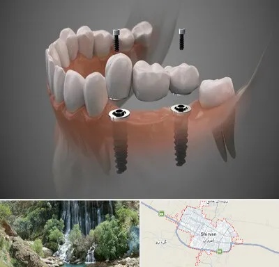 ایمپلنت دیجیتال در شیروان