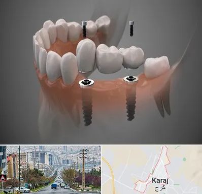 ایمپلنت دیجیتال در گوهردشت کرج 