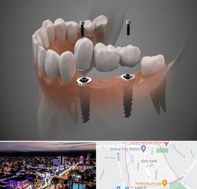 ایمپلنت دیجیتال در گلسار رشت 