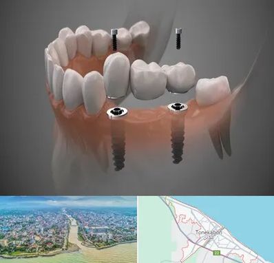 ایمپلنت دیجیتال در تنکابن