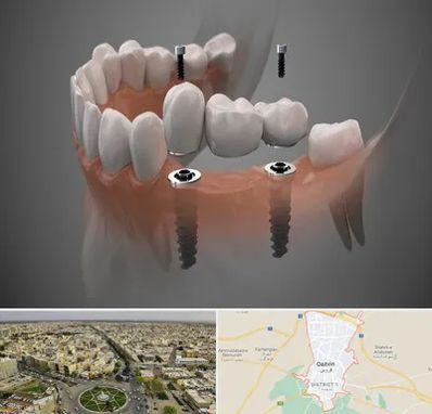 ایمپلنت دیجیتال در قزوین
