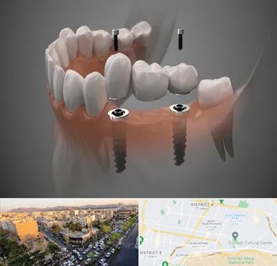 ایمپلنت دیجیتال در تهرانپارس 