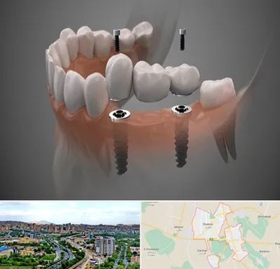 ایمپلنت دیجیتال در شهریار